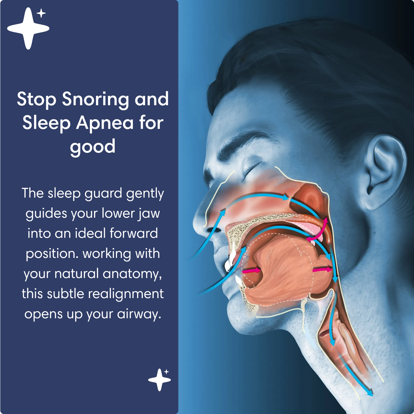 The Dream Cushion® Anti-Snore Mouth Piece